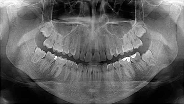 Digital Computed Panoramic - Cephalometric X-Rays
