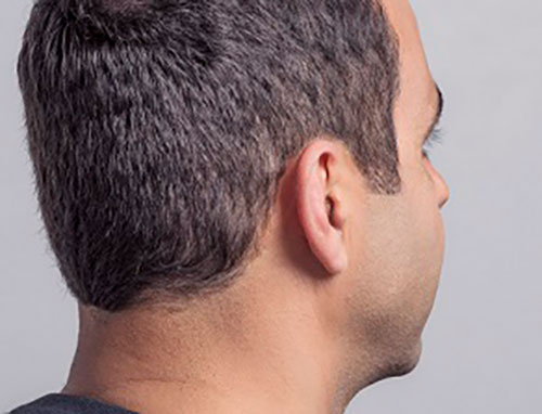 In-the-ear hearing aids