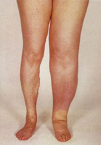 Leg Lymphedema