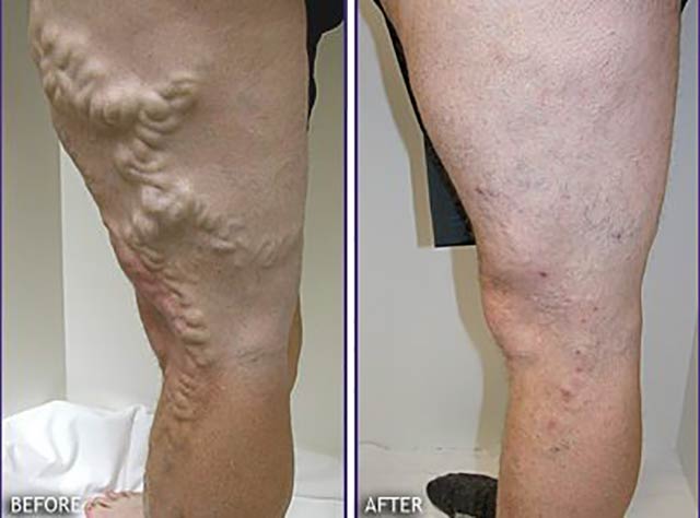 Repair of Varices