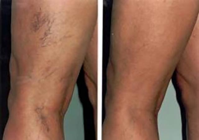 Repair of Telangiectasias