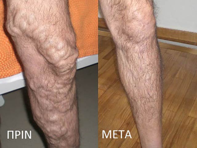 Repair of Varices