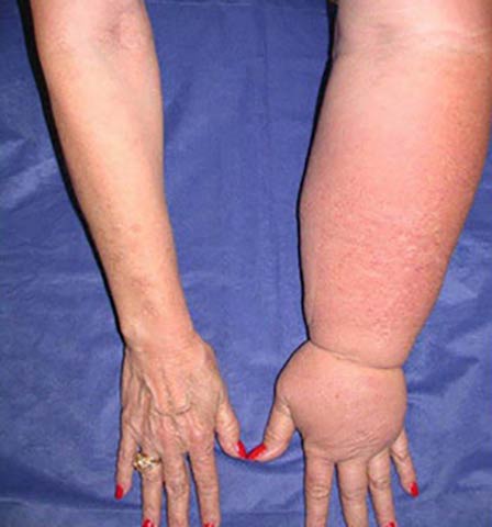 Lymphedema of the Upper Limb