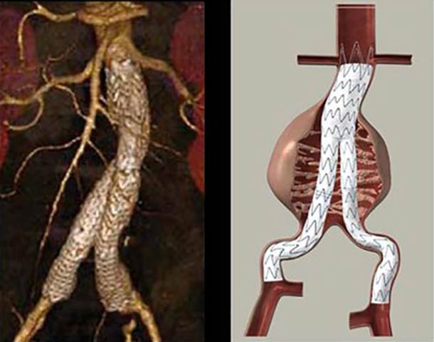Intraluminal Repair of Aortic Aneurysm