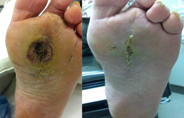 Foot Ulcer - Repair