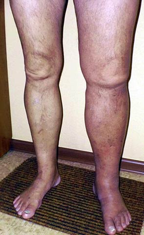 Venous Leg Thrombosis