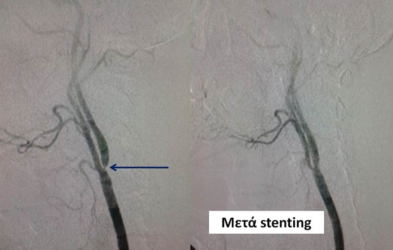 Carotid Angioplasty - Stenting