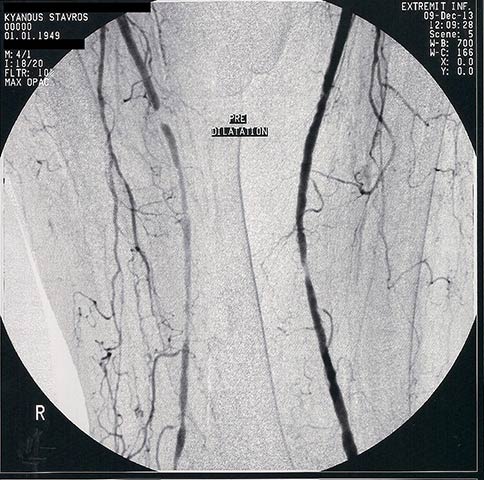 Atheromatosis of Arteries
