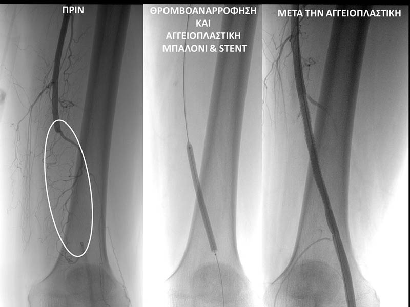 Angioplasty of the Femoral Artery