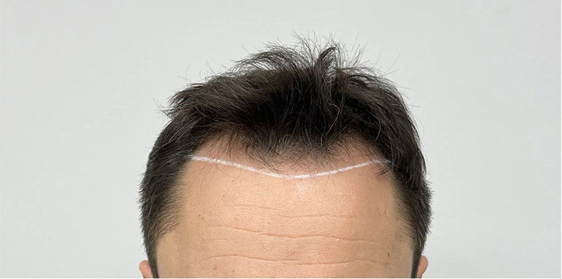 EPISTIMI HAIR CLINIC: Φωτογραφίες & Βίντεο
