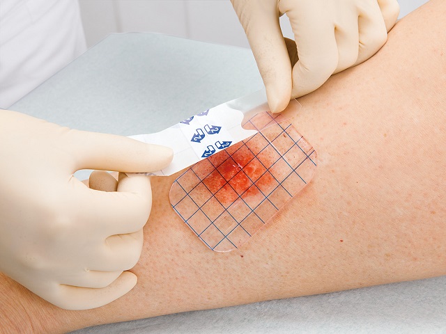 Patches and Pads for Wounds, Ulcers and Burns
