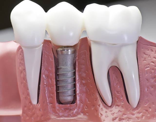 Dental implants