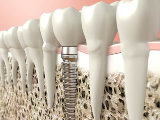 Implant