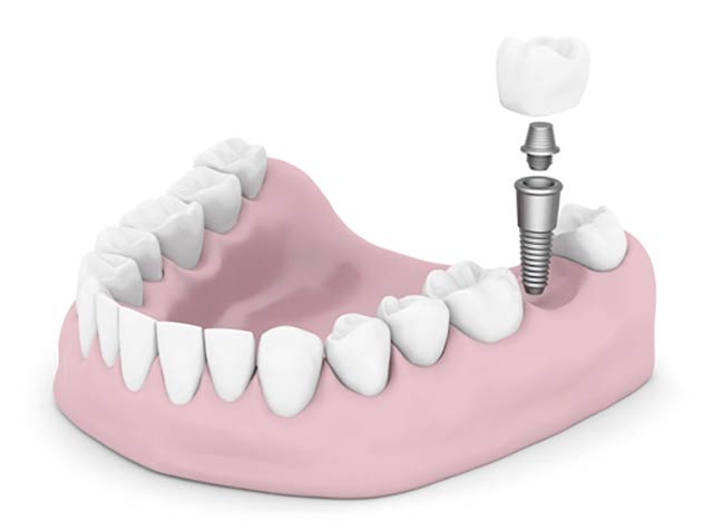 Implants