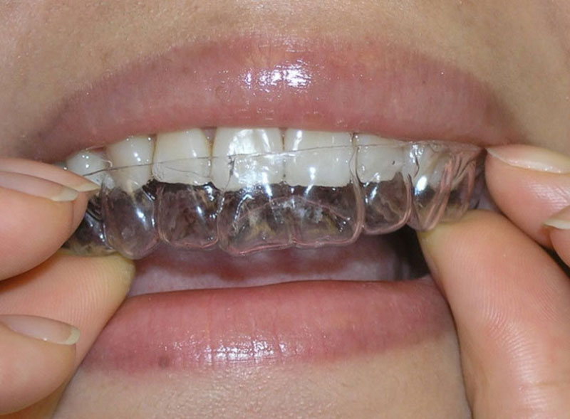 Invisalign