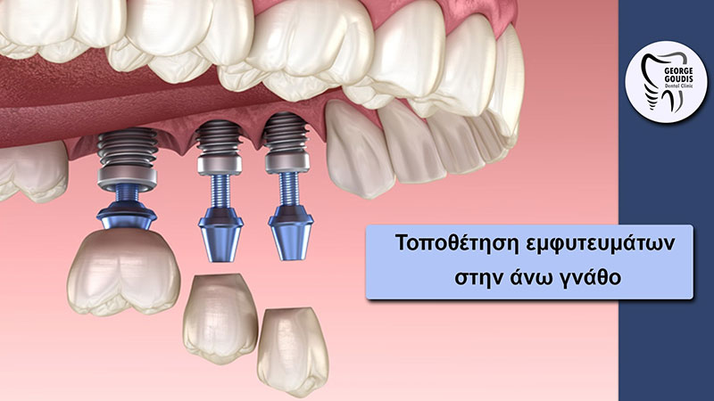 GOUDIS DENTAL CLINIC - GOUDIS GEORGIOS DDS: Φωτογραφίες & Βίντεο