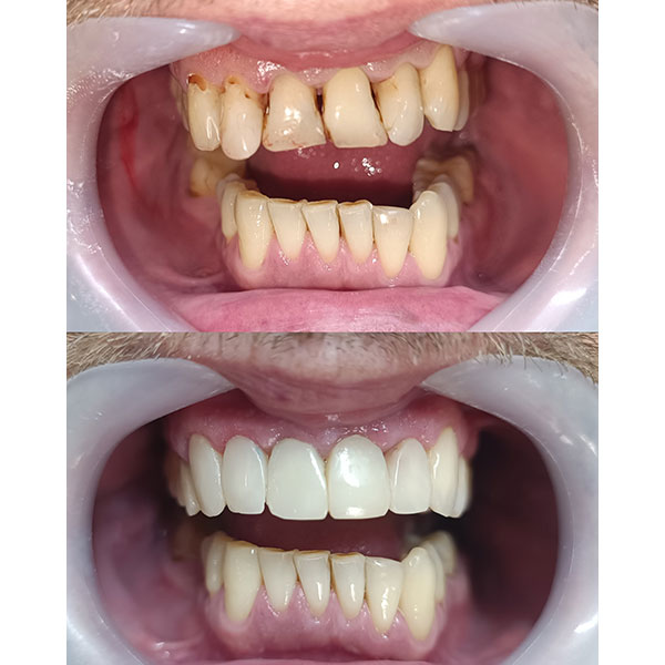 HAPPY TEETH - ΑΝΤΩΝΙΟΥ ΠΑΝΑΓΙΩΤΗΣ: Φωτογραφίες & Βίντεο
