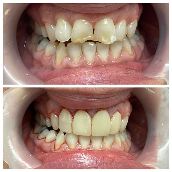 HAPPY TEETH - ΑΝΤΩΝΙΟΥ ΠΑΝΑΓΙΩΤΗΣ: Φωτογραφίες & Βίντεο