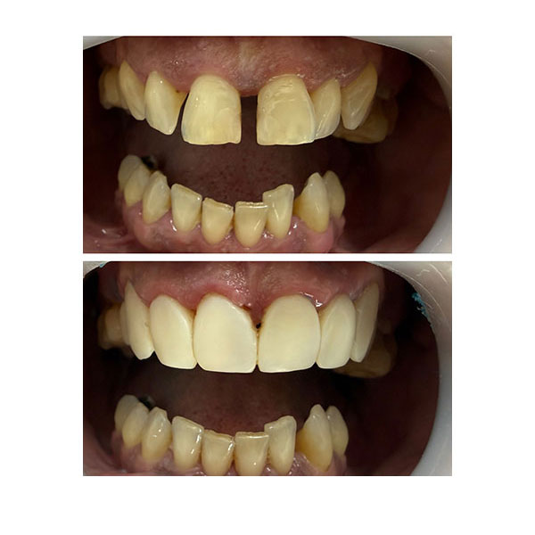 HAPPY TEETH - ΑΝΤΩΝΙΟΥ ΠΑΝΑΓΙΩΤΗΣ: Φωτογραφίες & Βίντεο