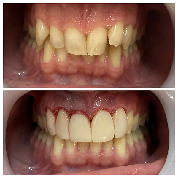 HAPPY TEETH - ΑΝΤΩΝΙΟΥ ΠΑΝΑΓΙΩΤΗΣ: Φωτογραφίες & Βίντεο