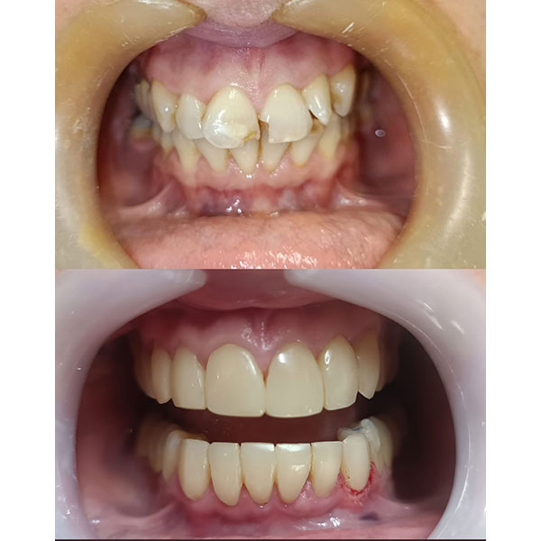 HAPPY TEETH - ΑΝΤΩΝΙΟΥ ΠΑΝΑΓΙΩΤΗΣ: Φωτογραφίες & Βίντεο