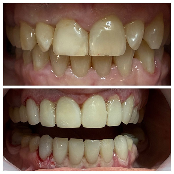 HAPPY TEETH - ΑΝΤΩΝΙΟΥ ΠΑΝΑΓΙΩΤΗΣ: Φωτογραφίες & Βίντεο