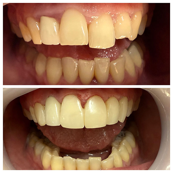 HAPPY TEETH - ΑΝΤΩΝΙΟΥ ΠΑΝΑΓΙΩΤΗΣ: Φωτογραφίες & Βίντεο