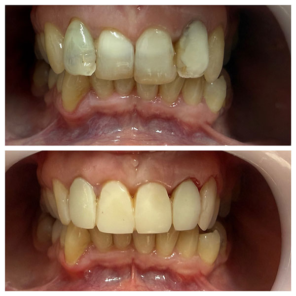 HAPPY TEETH - ΑΝΤΩΝΙΟΥ ΠΑΝΑΓΙΩΤΗΣ: Φωτογραφίες & Βίντεο