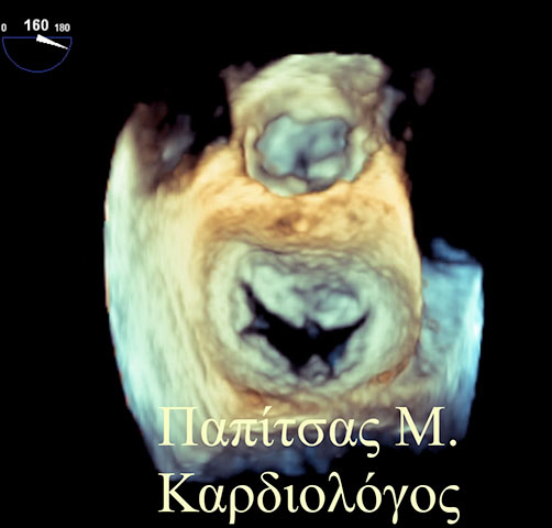 3D Διοισοφάγειο Υπερηχογράφημα