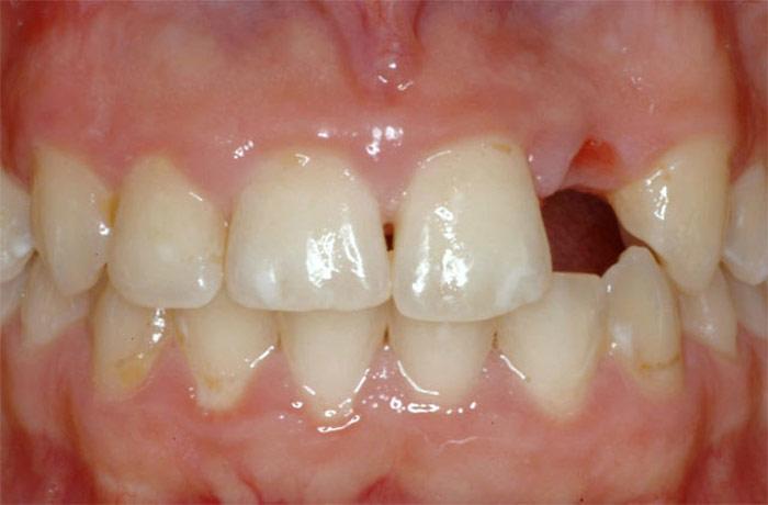 Prosthetic implants
