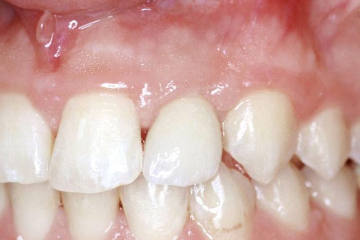 Reconstruction with an implant & connecting tissue graft