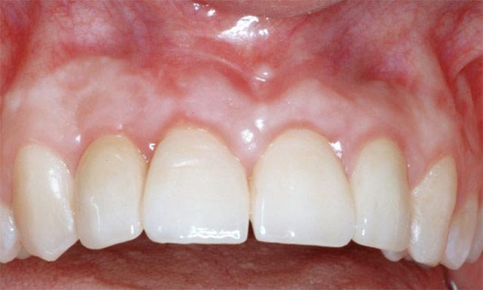 Reconstruction in the event of an accident with implants & bone grafts