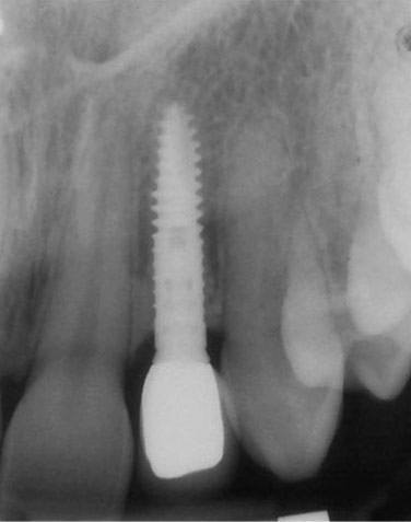 Final X-ray of the implant six years after its placement