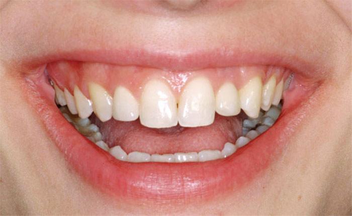 Placement of implants & gingival plastic surgery