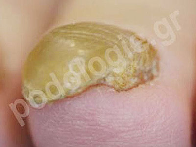 Onychogryphosis (thick, hard nails)