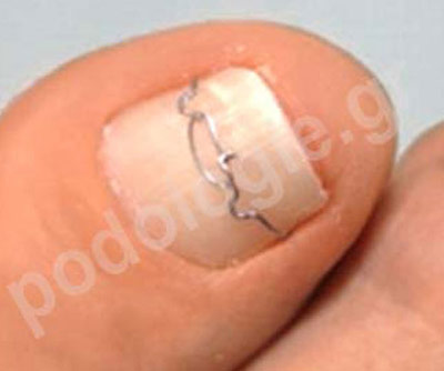 Nail correction, the solution to nail penetration into the skin (onychocryptosis)