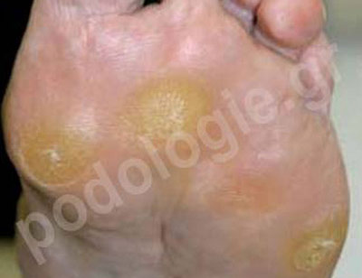 Skin hardening, metatarsal calluses