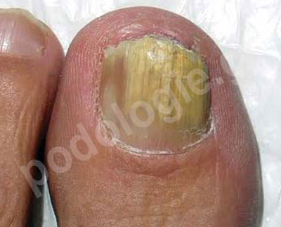 Nail fungi, alternative treatment with the Pact med method