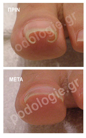 Restoration of nail penetration into the skin with nail correction brackets and plates