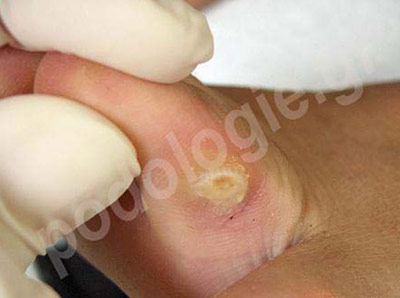 Cleaning of interdigital callus