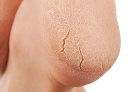 Skin hardening, heel hyperkeratosis with deep stretch marks