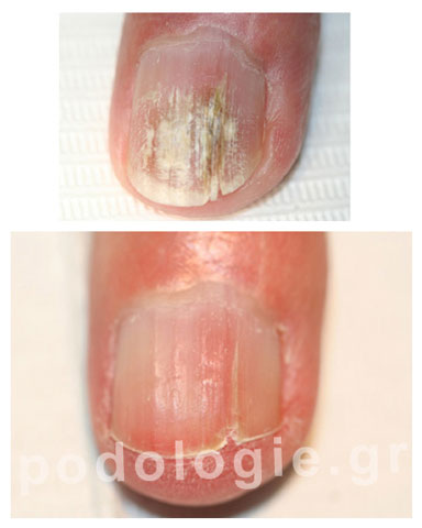 Alternative treatment of onychomycosis after 3 months, with the photodynamic Pact med equipment
