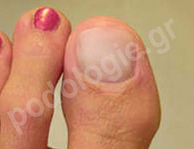 Onychoplasty (restoration of nails in case of malformation, injury, nail removal, etc) for therapeutic/aesthetic reasons