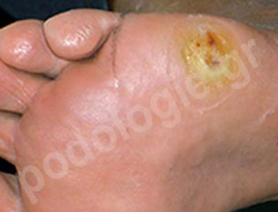 Treatment of ulcer on a diabetic foot