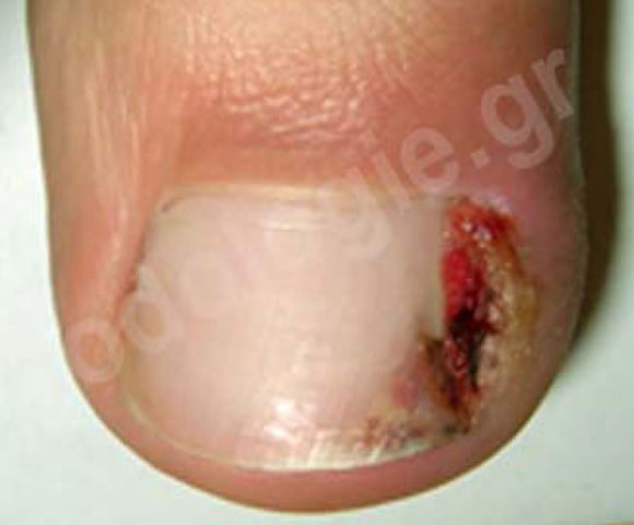 Nail penetration into the skin with inflammation, redness and swelling