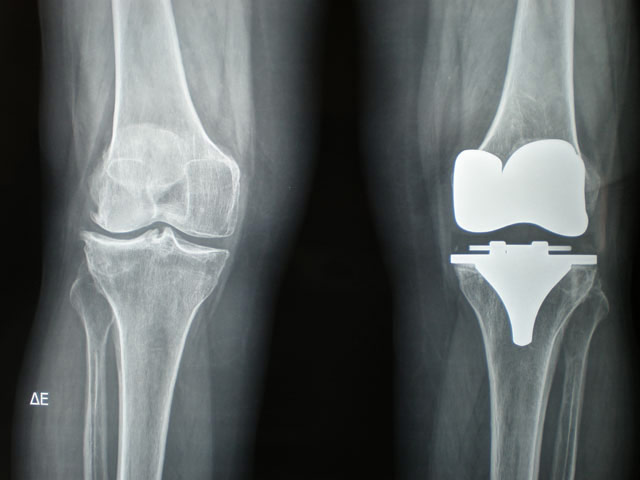 Knee replacement surgery