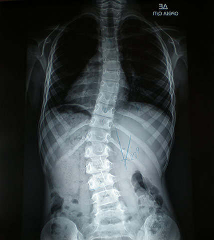 Scoliosis