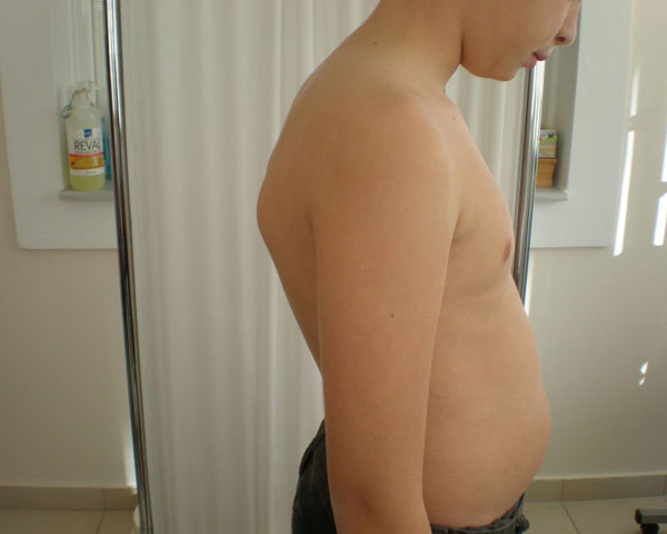 Kyphosis