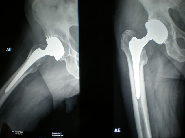 Hip replacement surgery