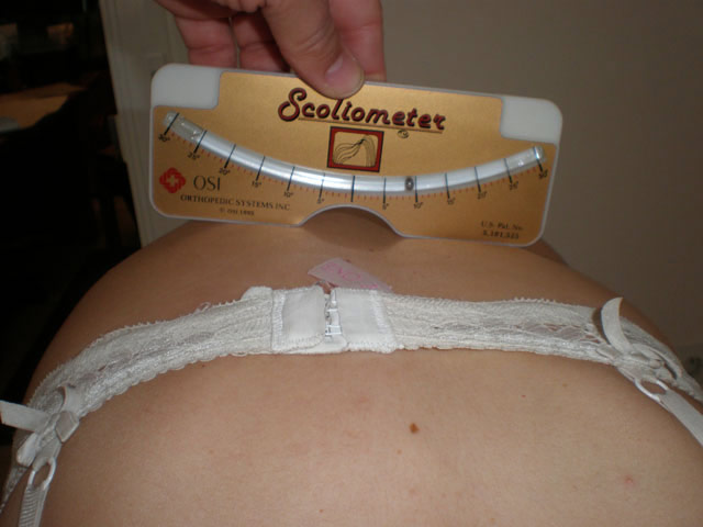 Scoliosis
